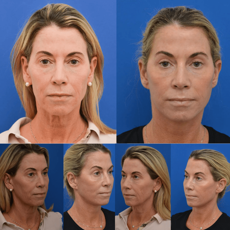 Face Glow 2.0® - Definição e Rejuvenescimento + Brinde